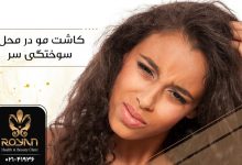 کاشت مو در محل سوختگی سر