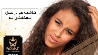 کاشت مو در محل سوختگی سر