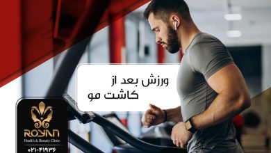 ورزش بعد از کاشت مو
