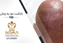 کاشت مو به روش FUE
