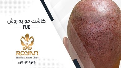 کاشت مو به روش FUE