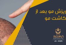 ریزش مو بعد از کاشت مو