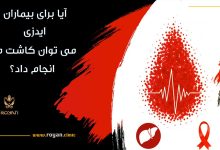 کاشت مو برای بیماران ایدزی