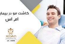 کاشت مو در بیماران MS
