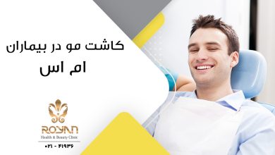 کاشت مو در بیماران MS