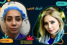 نمونه تزریق چربی صورت