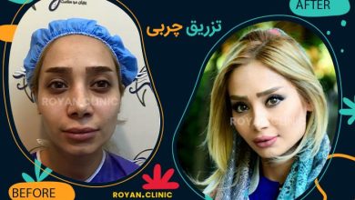 نمونه تزریق چربی صورت