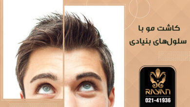 کاشت مو سلول های بنیادی