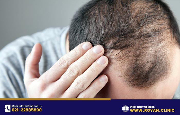ریزش موی ارثی در مردان