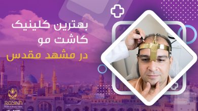 بهترین کلینیک کاشت موی مشهد