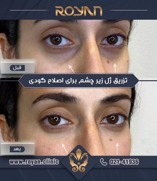 نمونه تزریق ژل گودی چشم