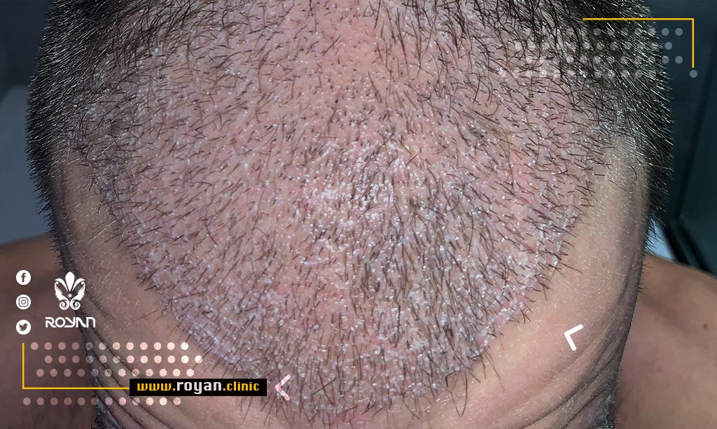 علت پوسته پوسته شدن سر بعد از کاشت مو