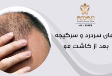 سردرد بعد از کاشت مو