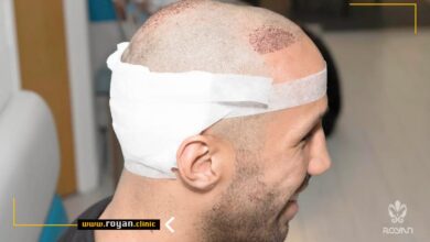 ضربه به سر بعد از کاشت موی طبیعی