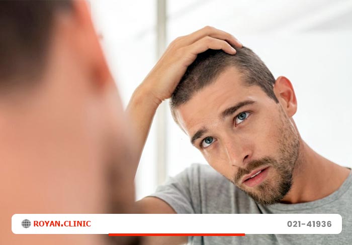 ریزش مو در مردان جوان