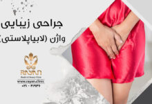 لابیاپلاستی