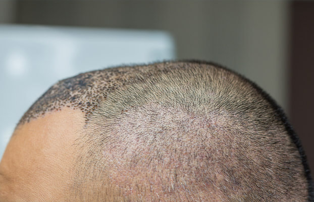 تورم بعد از کاشت مو چگونه از بین میرود؟