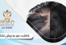 کاشت مو به روش تکثیر