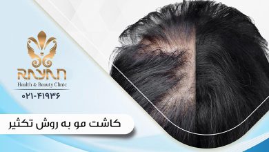 کاشت مو به روش تکثیر