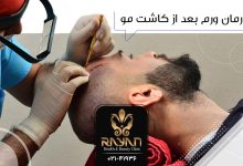 ورم بعد از کاشت موی طبیعی