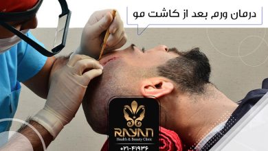ورم بعد از کاشت موی طبیعی