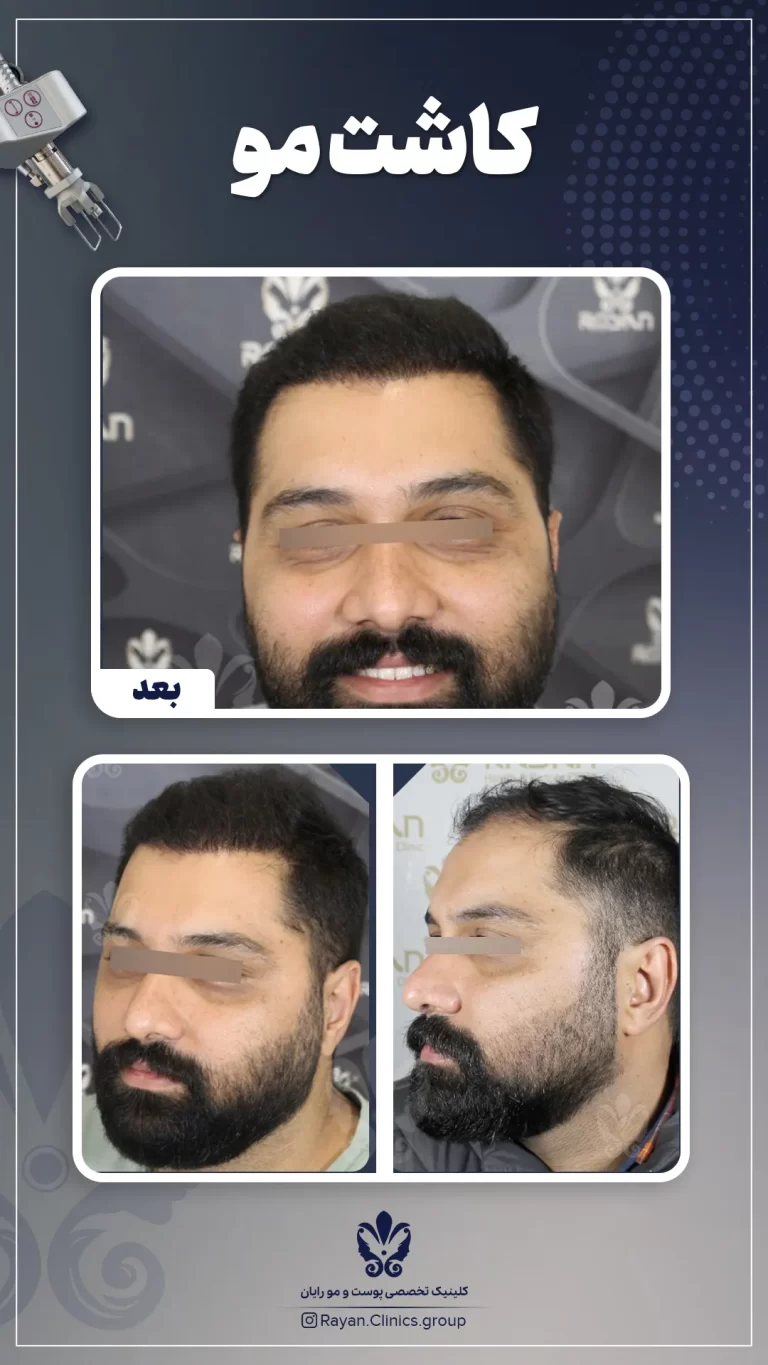 Before After 2.10.1