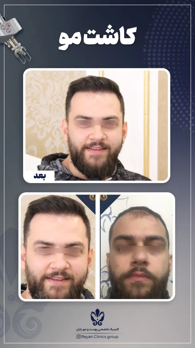 Before After 2.11.1