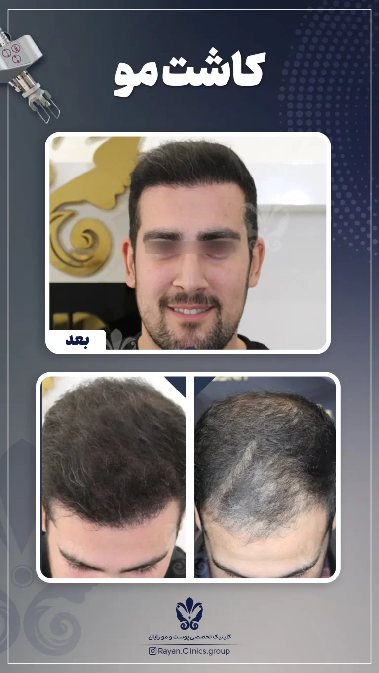 Before After 2.12.1