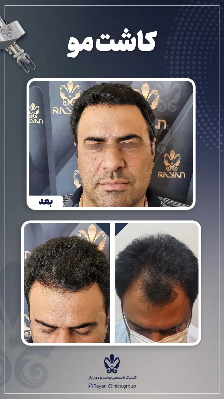 Before After 2.13.1