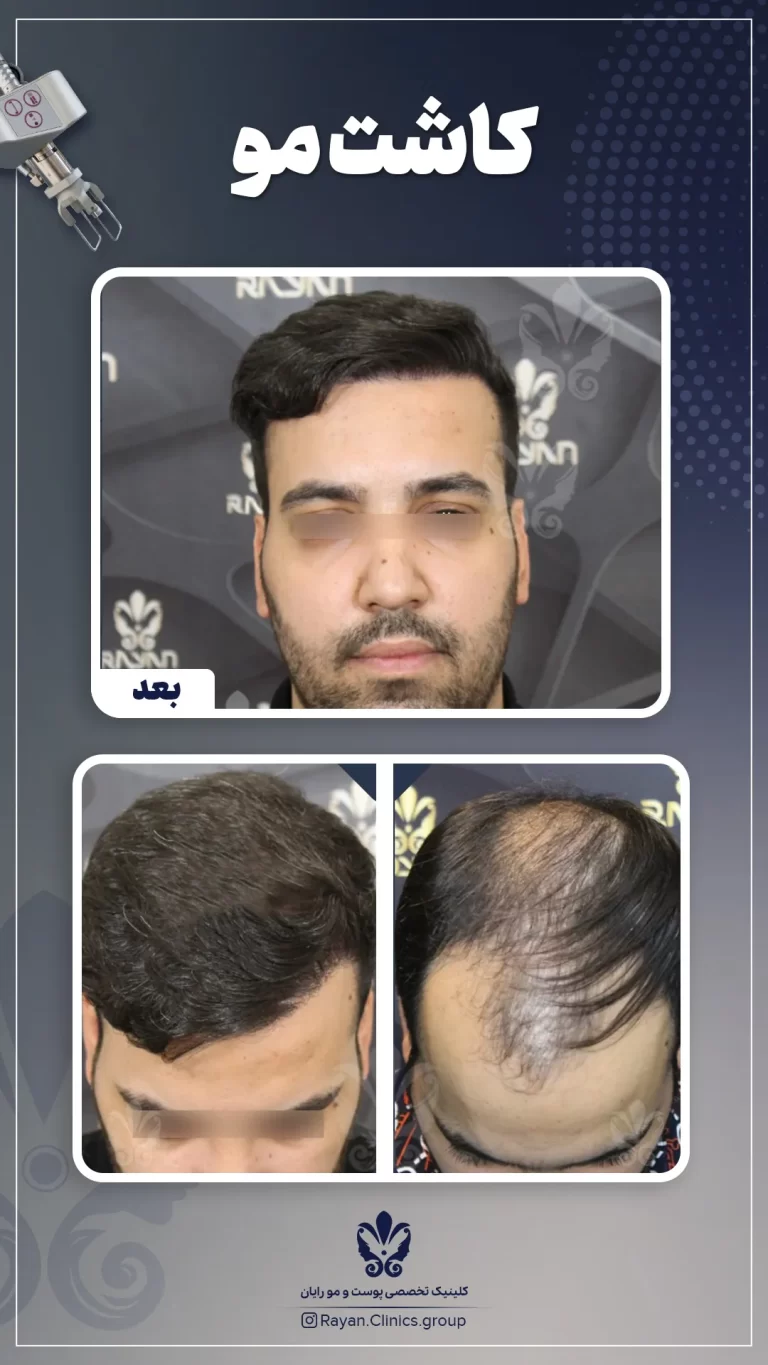 Before After 2.14.1