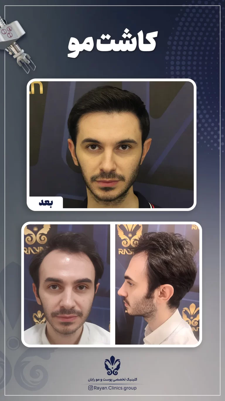 Before After 2.15.1