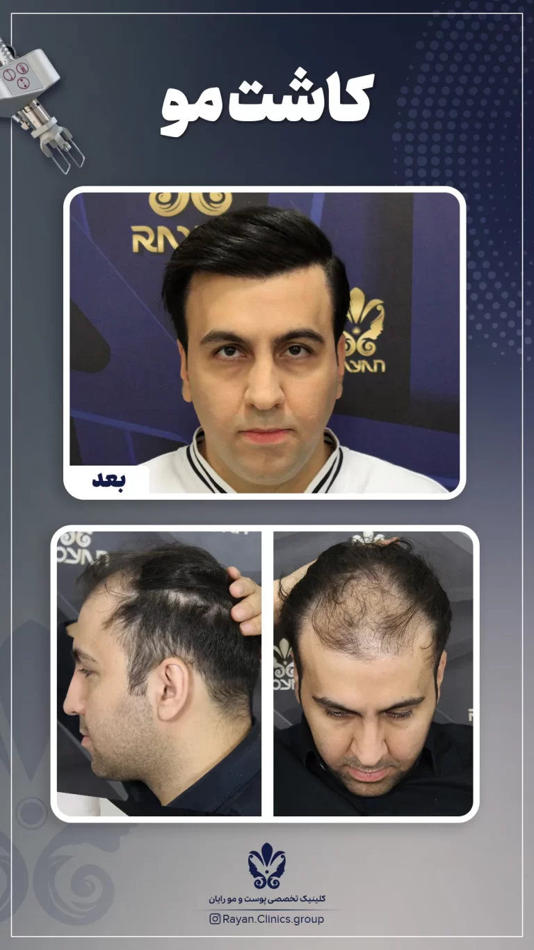 Before After 2.16.1