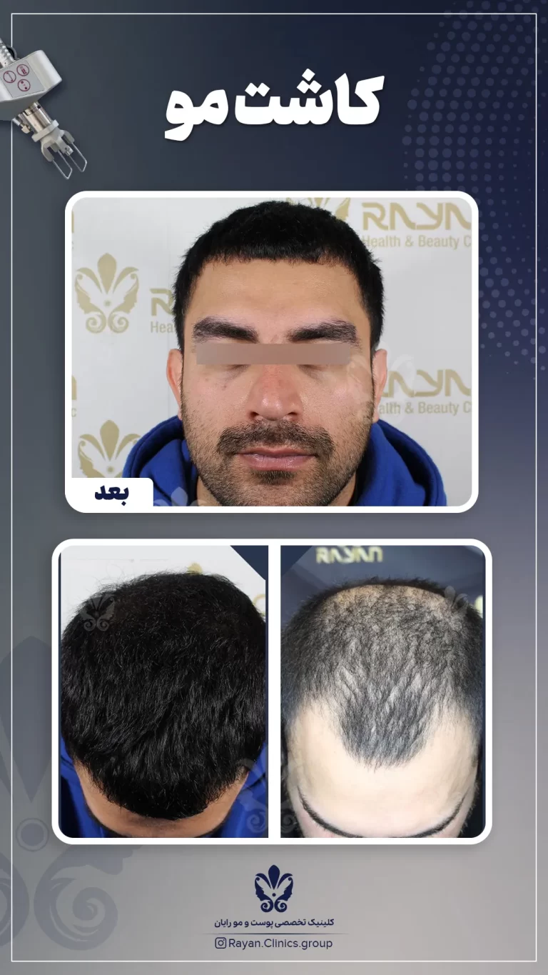 Before After 2.2.1