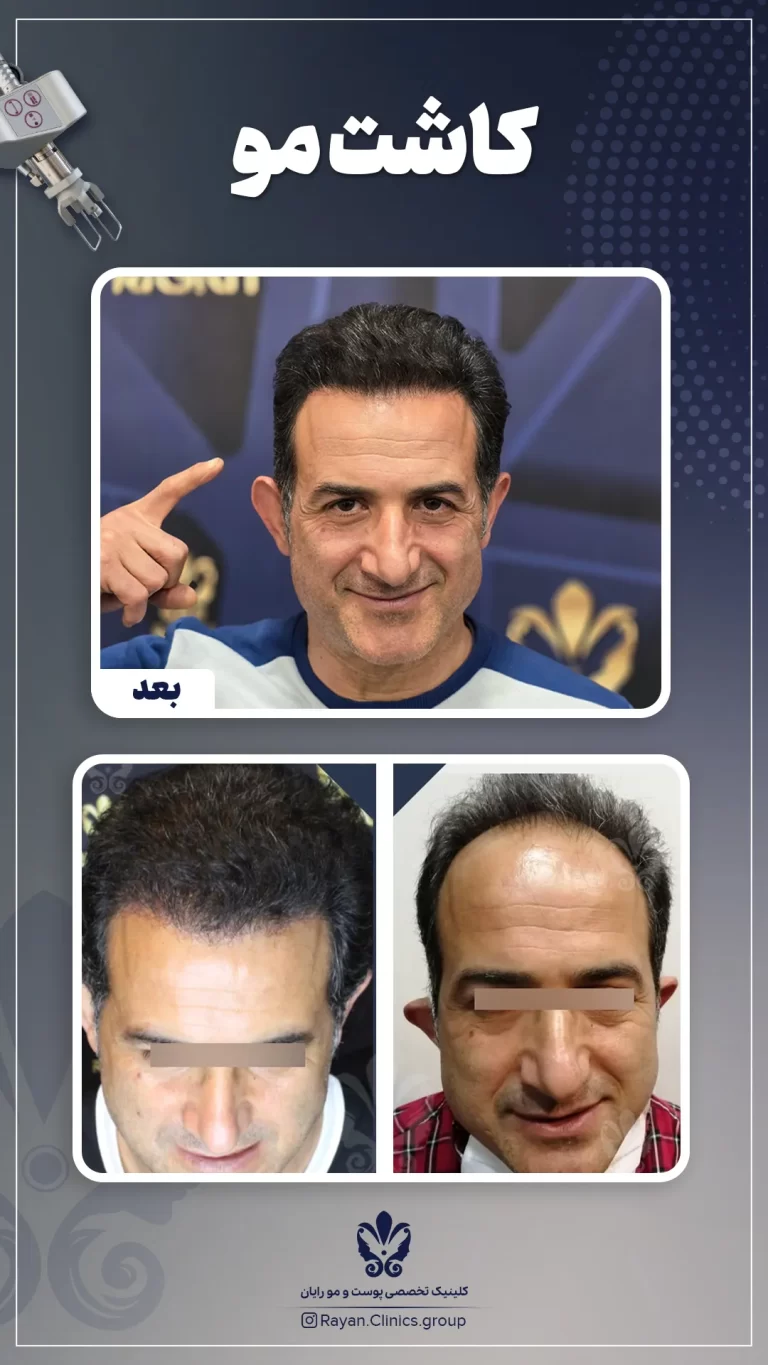 Before After 2.3.1