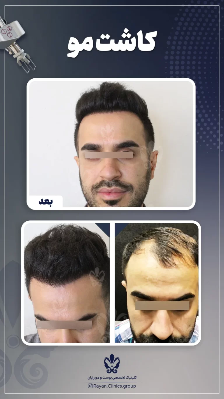 Before After 2.5.1
