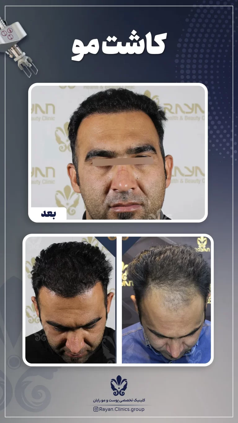 Before After 2.6.1