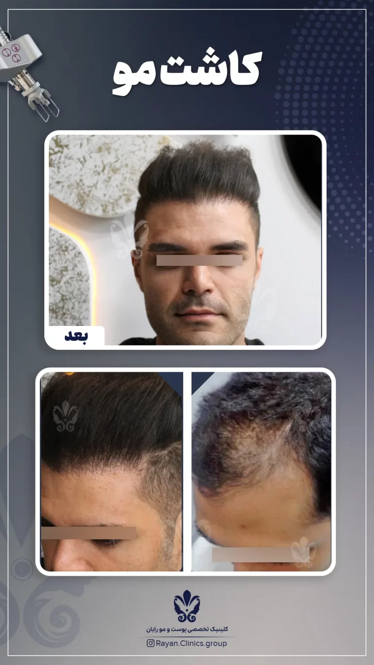 Before After 2.7.1