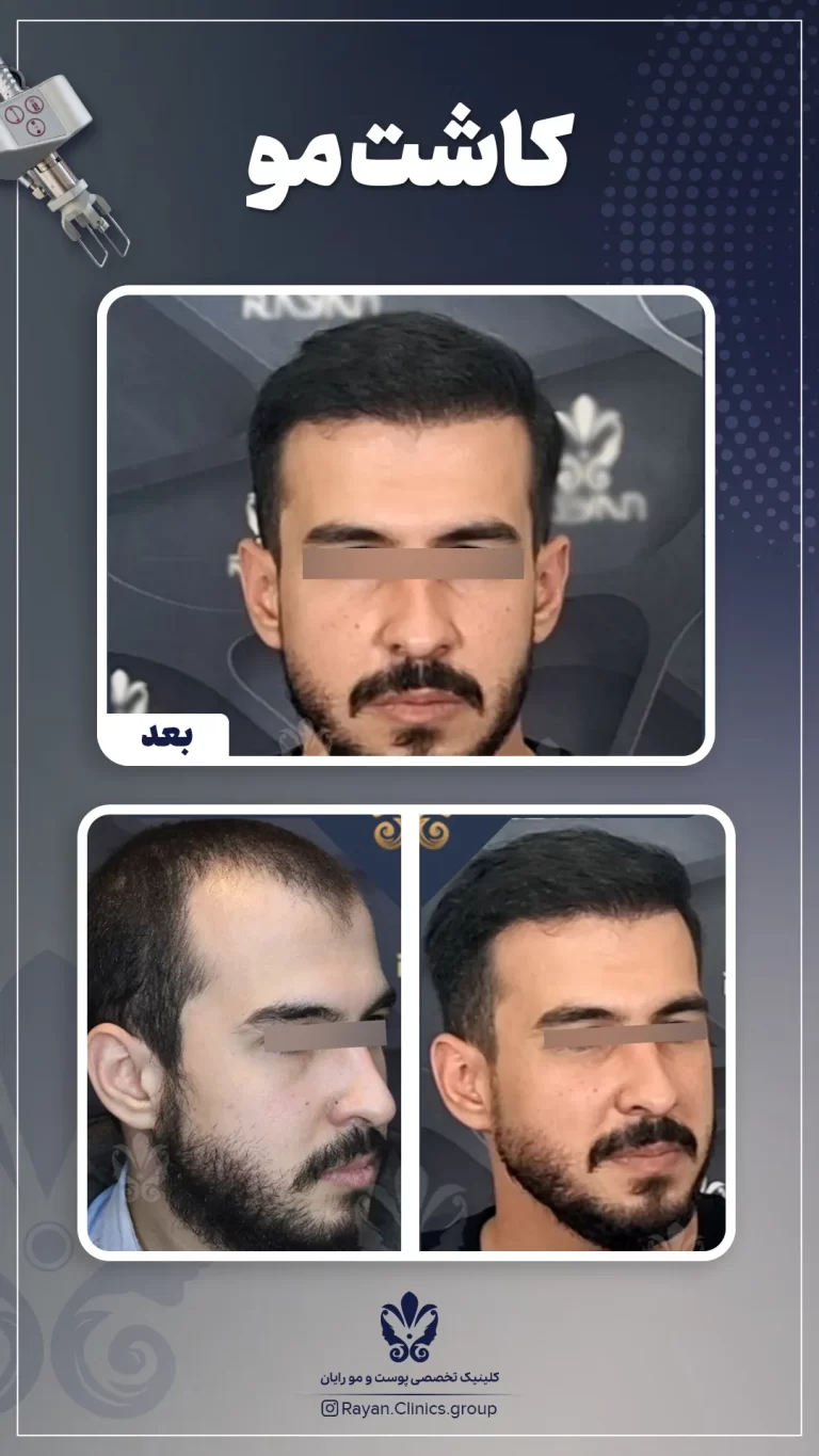 Before After 2.8.1